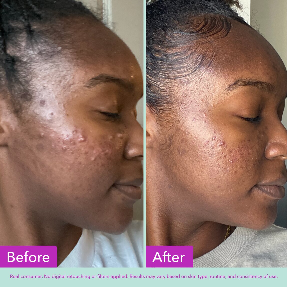 acne-foaming-cleanser-u3 zb_p.jpg